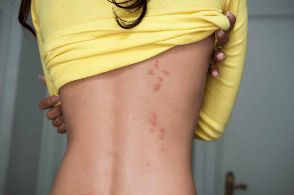 Bettwanzen Bisse Flohbisse Unterschied