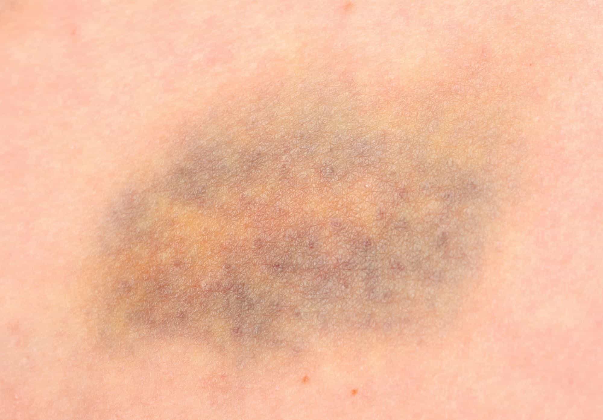 rote flecken am bein bilder